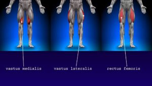 Train deze spieren bij artrose: de quadriceps. Bestaande uit de vastus medialis, vastus lateralis, vastus intermediu en de rectus femoris.