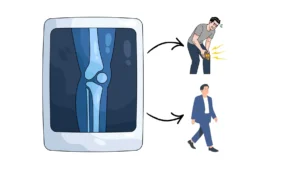 Relatie radiografische artrose en symptomen zoals pijn.