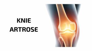 Wat is artrose? Artrose in de knie.