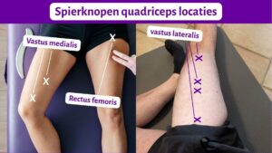 Spierspanning (in de vorm van spierknopen) kan kniepijn veroorzaken. Pijn bij artrose kan komen door spierknopen en niet alleen door de veranderingen in het gewricht.